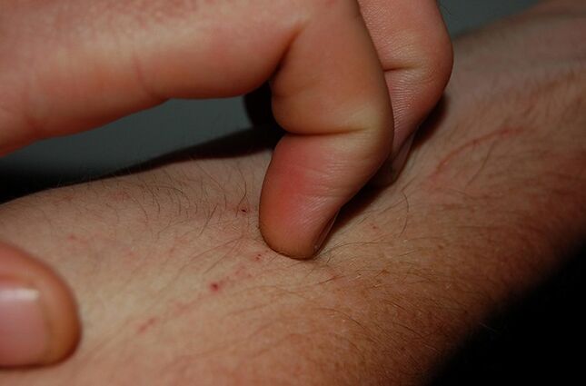 coceira na pele como sintoma da presença de parasitas