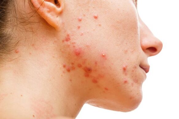 acne devido a parasitas subcutâneos