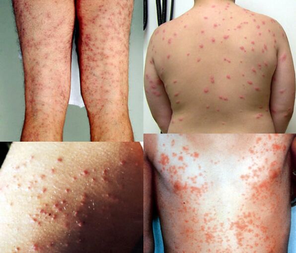erupção cutânea em todo o corpo devido a parasitas
