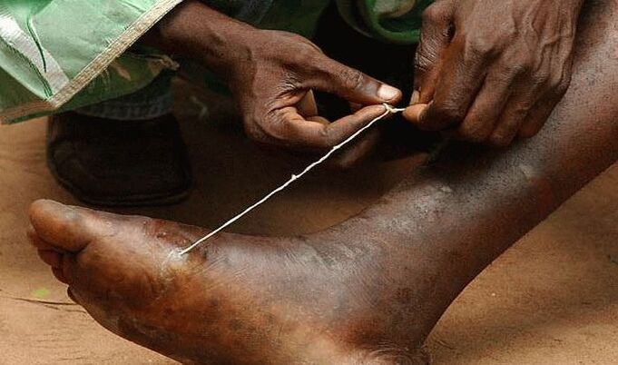 extração de parasita subcutâneo do pé