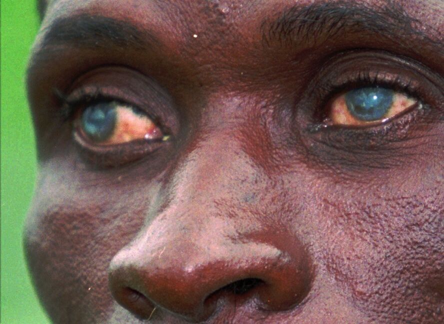 parasitas nos olhos humanos
