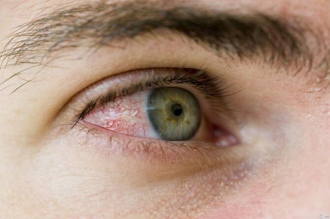 problemas oculares devido a parasitas
